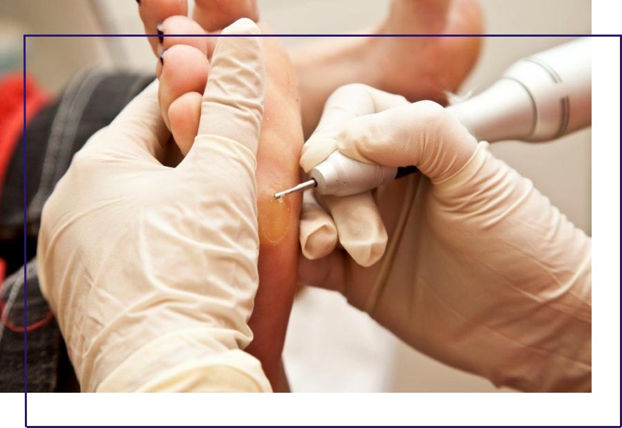 Tratamento de verruga plantar em Cubatão na Clínica Arte Pé
